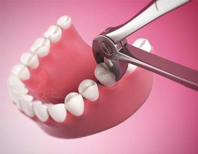 Forceps gripping tooth during tooth extraction in Indianapolis