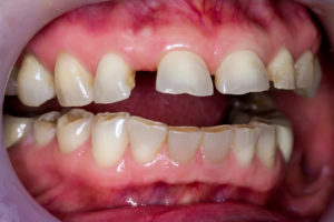 Closeup of severely damaged and decayed smile