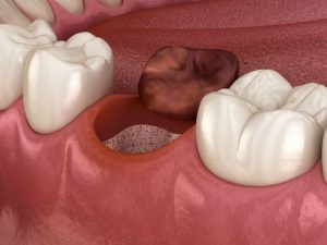 Illustration showing dry socket after tooth extraction